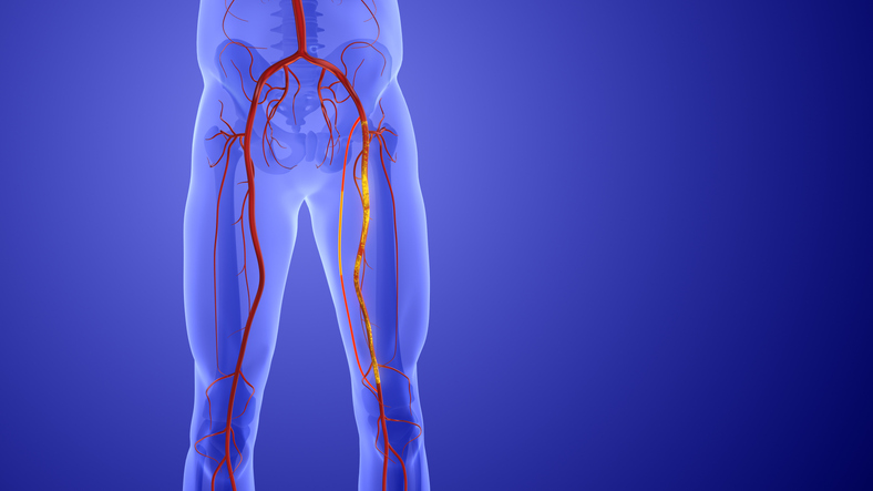 That Leg Pain May Not Be Aging. It Could Be PAD